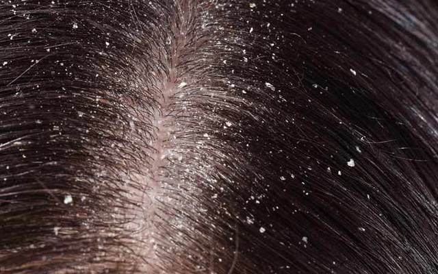 Dandruff की वजह से बाल क्यों झाड़ने लगते हैं