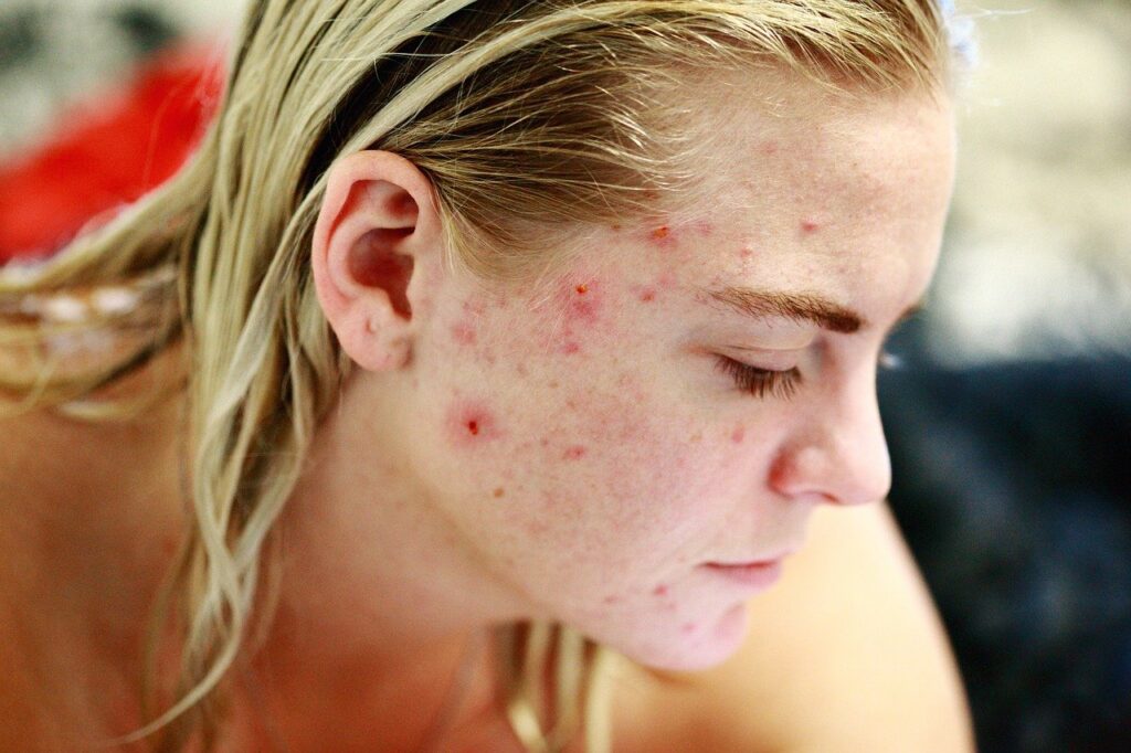 Home made pack for pimples